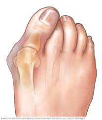 Bunion case study 3